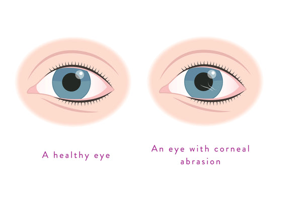 Corneal abrasion