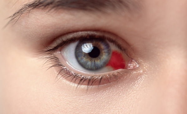 Close-up of an eye showing a subconjunctival hemorrhage, with a prominent red patch on the white part of the eye.