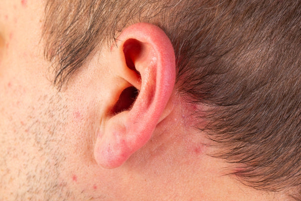 Red ears: causes, symptoms and when to seek advice
